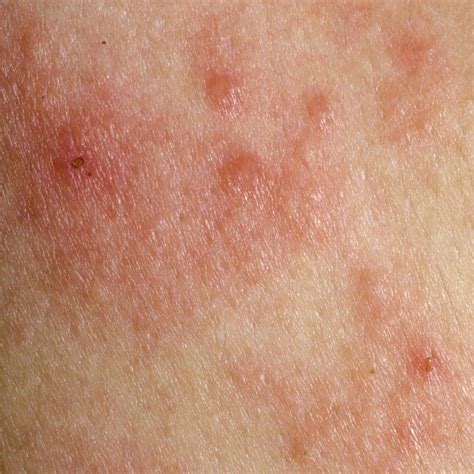 Itchy Rash On Joints Causes Of Itchy Skin Usually At The Beginning