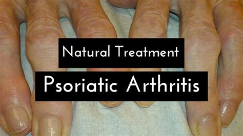 Psoriatic Arthritis Natural Remedies Jmexclusives Research Guide