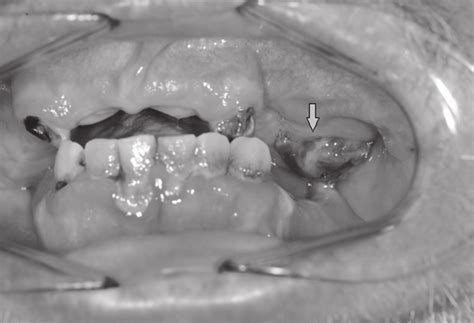 Preoperative Intraoral View Showing A Protruding Mass In The Left