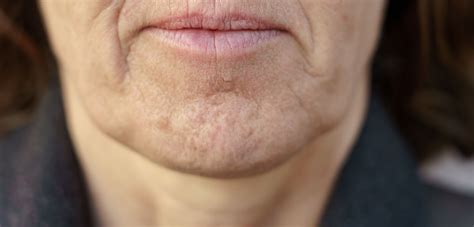 Dimpled Chin Lines Anti Aging
