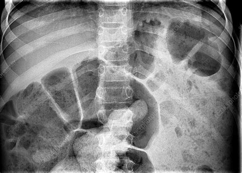 Bowel Obstruction X Ray Stock Image C0382435 Science Photo Library
