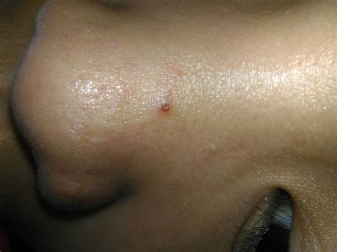 How To Get Rid Of Blackhead Scab General Acne Discussion