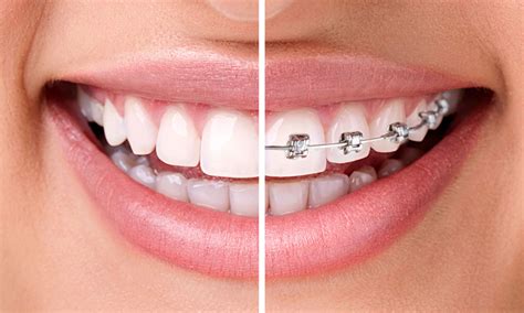 ortodoncia todo lo que debes saber clínica dental de niños y adultos en madrid