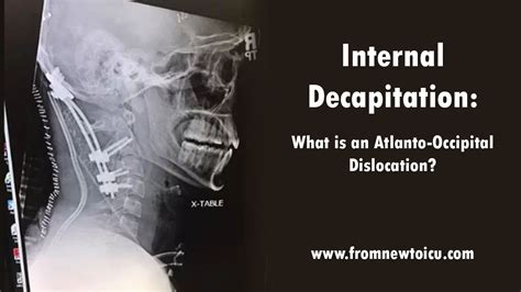 Trans Atlanto Dislocation What Is Internal Decapitation — From New To Icu