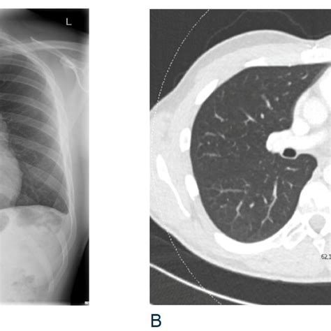 A Follow Up Chest X Ray Showing A Broadened Aorto Pulmonary Window A