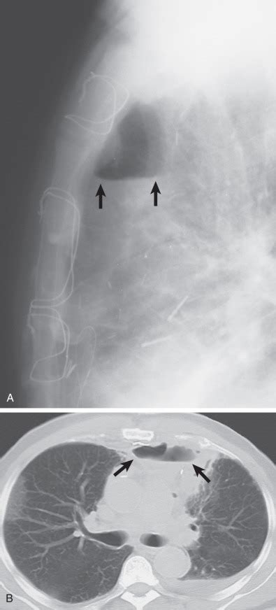 Mediastinitis Radiology Key