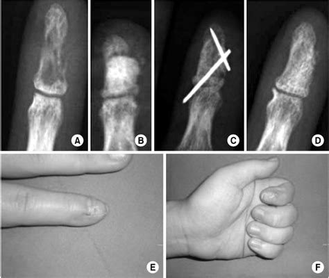 A Year Old Man Sustained Distal Phalanx Open Fracture Of Left Index Download Scientific