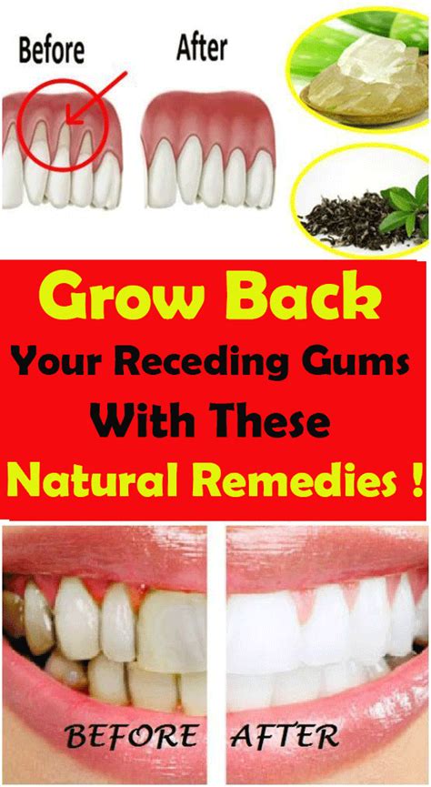 Grow Back Your Receding Gums With These Natural Remedies Health And