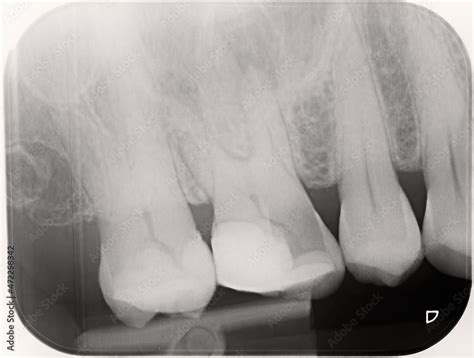 Xray Of Four Human Upper Right Teeth The Second Molar Has Been Heavily Filled And Part Of The