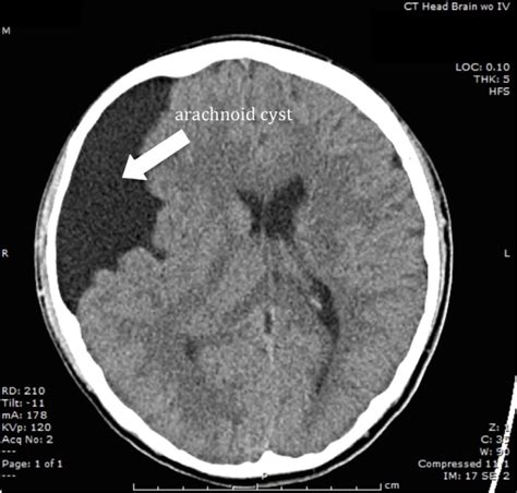 Image Diagnosis Arachnoid Cyst The Permanente Journal
