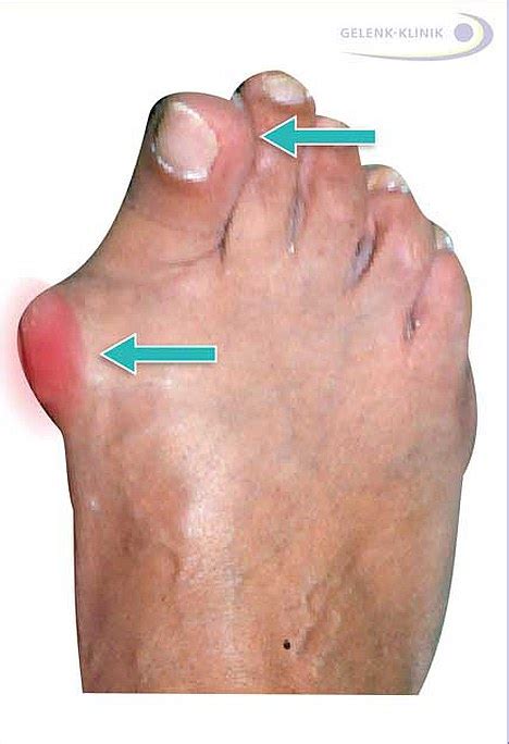 Hallux Valgus The Ganglion On The Big Toe Conservative Treatment Or