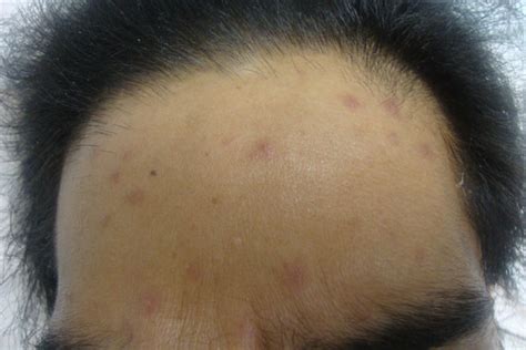 Derm Dx Painless Red Bumps On Face And Body In A Man With Hiv