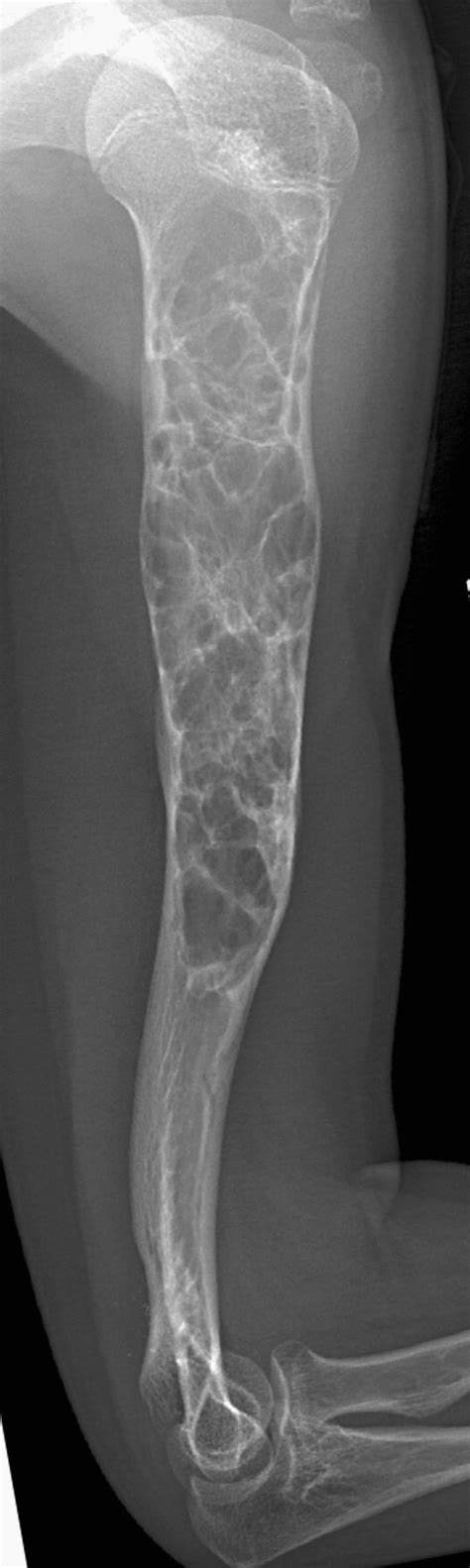 Successful Treatment Of Humeral Giant Aneurysmal Bone Cyst Value Of