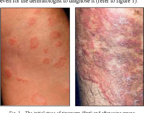 Figure 1 From Differential Diagnosis Of Ringworm And Eczema Using Image