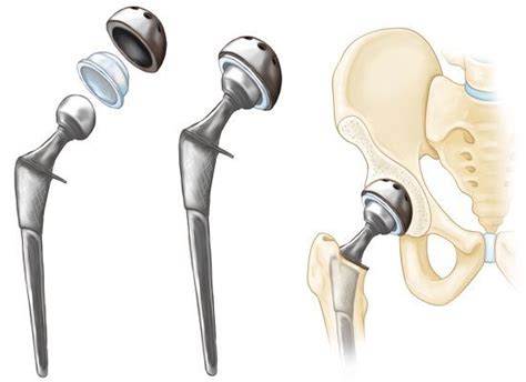 Total Hip Replacement Exercise Guide Orthoinfo Aaos Hip