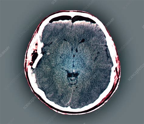 Traumatic Brain Injury Ct Scan Stock Image C0551373 Science