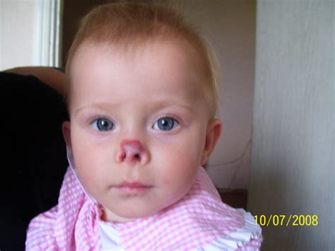 Hemangioma In Nose Pictures 28 Photos And Images