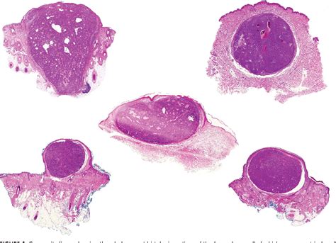 Figure 1 From Primary Cutaneous Apocrine Carcinoma Versus Metastasis
