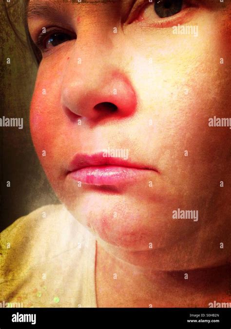 Misery A Swollen Face From An Abscessed Tooth 2 Stock Photo Alamy