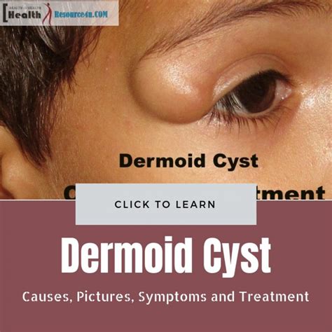 Dermoid Cyst Liberal Dictionary