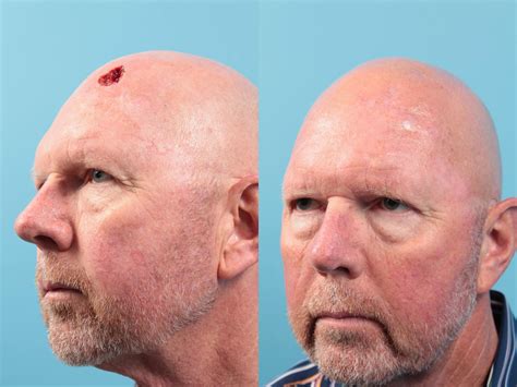 Skin Cancer Repair Before And After Pictures Case 82 West Des Moines