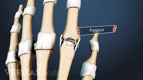 What Is Pannus Arthritis Health