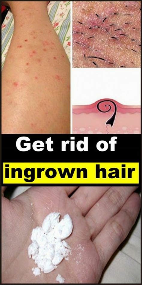 How To Get Rid Of Ingrown Hair Skin Name Ingrownhairbikini Ingrown