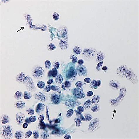 Mucosa Associated Lymphoid Tissue Lymphoma The Nuclei Of Lymphoma