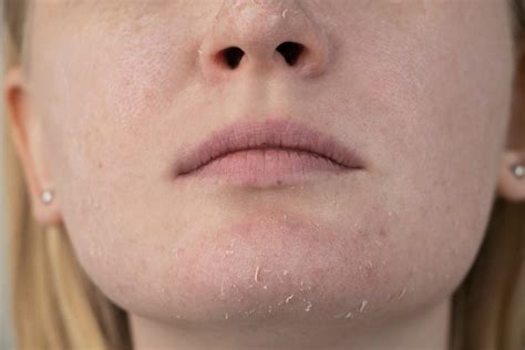 Шелушится кожа на лице почему и что делать советы дерматолога РБК Стиль