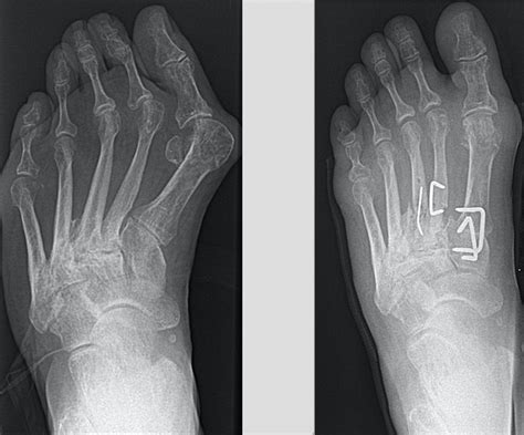 Metatarsal Osteotomy Foot Treatment Visa Medicure
