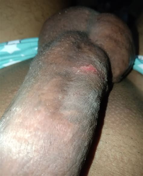 Injury To The Penis 3 Pics Xhamster