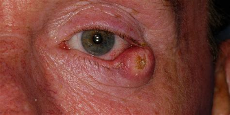 Skin Cancer On Upper Eyelid