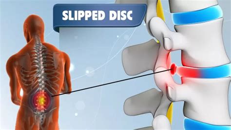 Effective Physiotherapy For Disc Bulges Sciatica And Chronic Back Pain