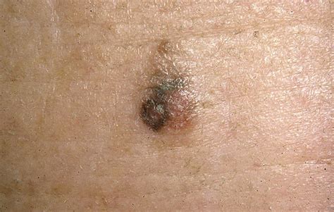 Early Melanoma Pictures 54 Photos And Images