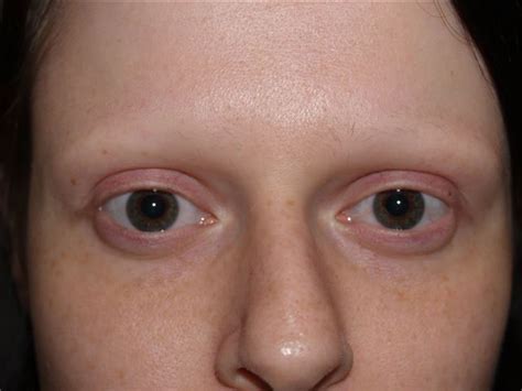 Those factors could be hormonal disorders, diet, and various skin conditions. Patient 49, Eyebrow and Eyelashes Photo Gallery