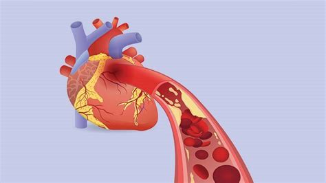 Heart Attack Causes And Risk Factors