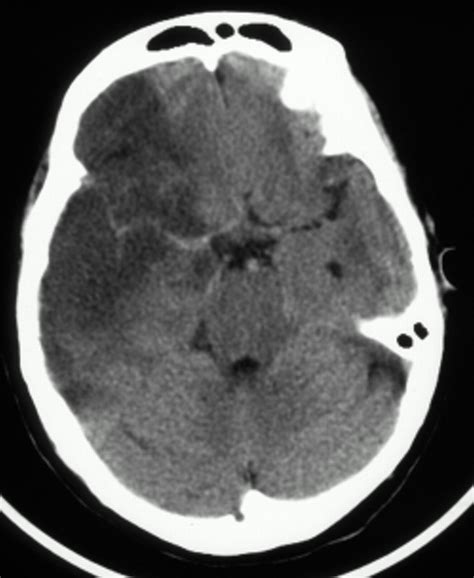 This finding indicates a focal clot in the left middle cerebral artery (arrow). Early computed tomography features in extensive middle ...