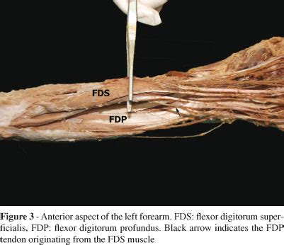 The muscular system can be broken down into three types of muscles: An anomaly of flexor muscles of the fifth (little) finger ...