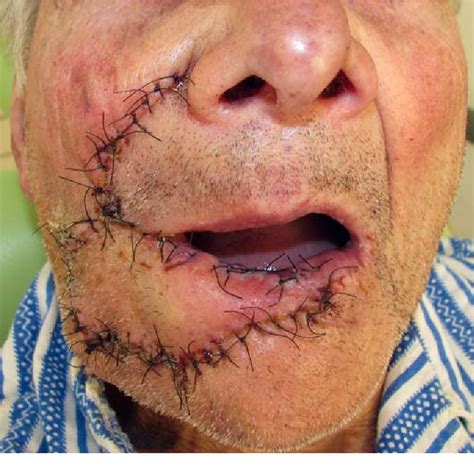 #turnstile #turnstilegate#accesscontrol #rfidsystem#speedgate#flapbarrier# flap barrier gate#swingturnstile#rfidsystem#speedgate#flapbarrier#turnstilemanufacturers#. Figure 5 from Lower Lip Reconstruction Using Unilateral ...