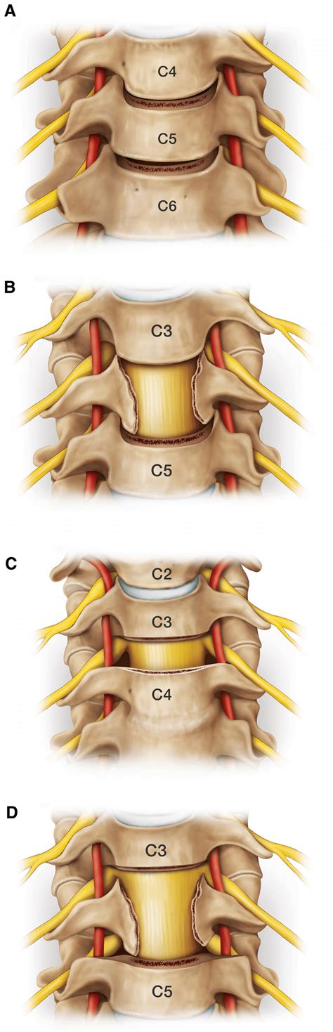 Illustrations Show Four Different Grades Of Anterior Osteotomies A