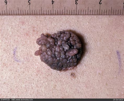 Stock Image Close Up Of A Papillomatous Dermal Nevus Mole A Raised