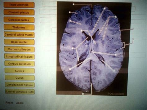 Solved Click And Drag The Label To Their Correct Locations Third Ventricle Choroid Plexus