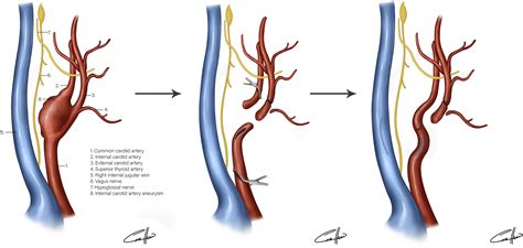 Management Of An Extracranial Internal Carotid Artery Aneurysm