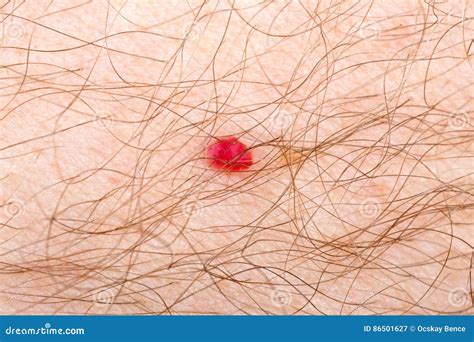 Cherry Angioma On Human Skin Stock Image Image Of Hemangioma Blemish