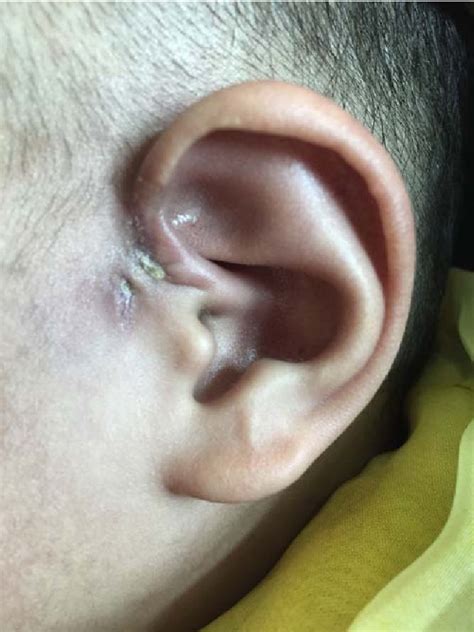 Postoperation Of Preauricular Fistula Cellulitis Caused By Methicillin