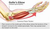 Golfers Elbow Recovery Time