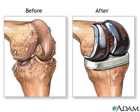 How Rheumatoid Arthritis Affects Each Part Of The Body Total Knee