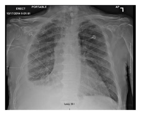 Chest X Ray Showed A Right Lung Infiltrate And Moderate Right Pleural