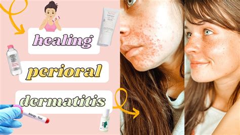 How I Healed My Perioral Dermatitis What Works And What Doesn T Product Recommendations