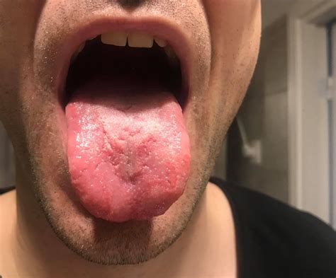 Geographic Tongue Since Being With A Girl Oral And Dental Problems